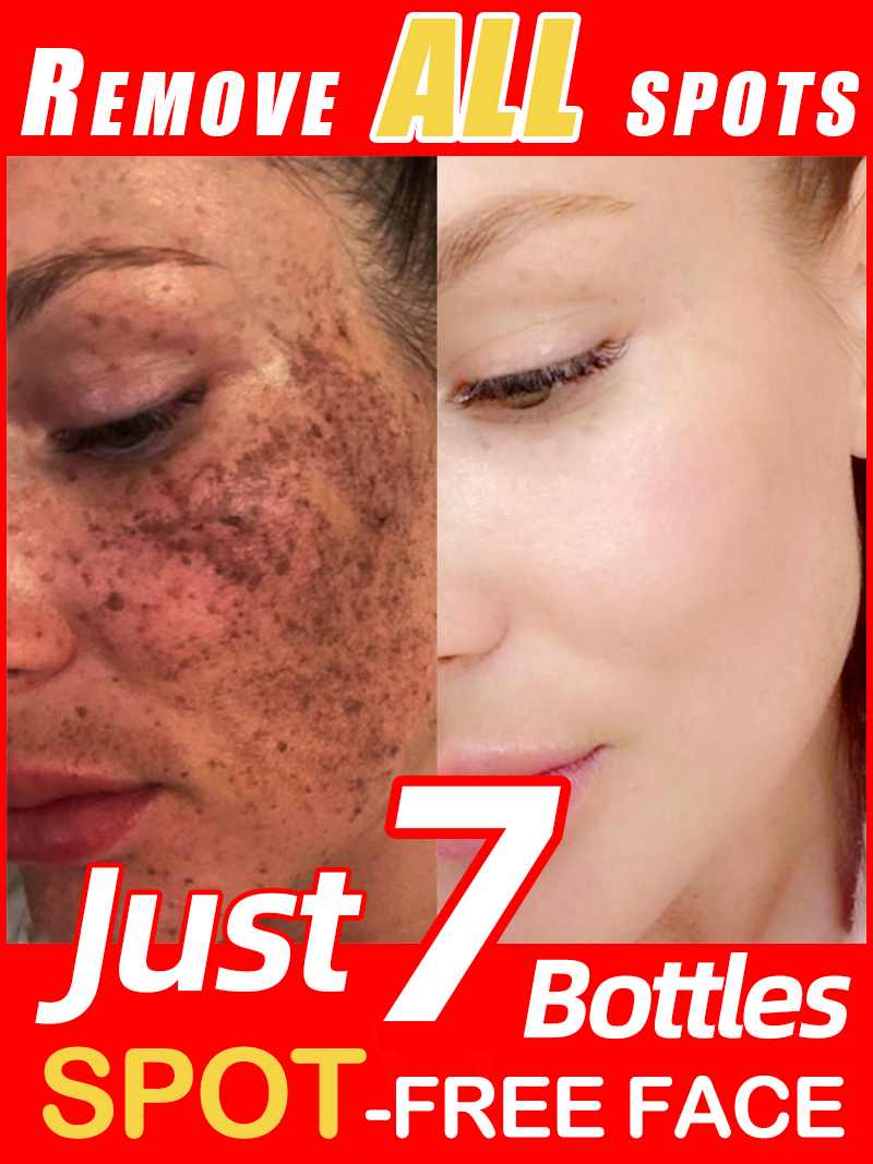 Éclairer les taches de rousseu - Luxury Skincare Essence avis et prix